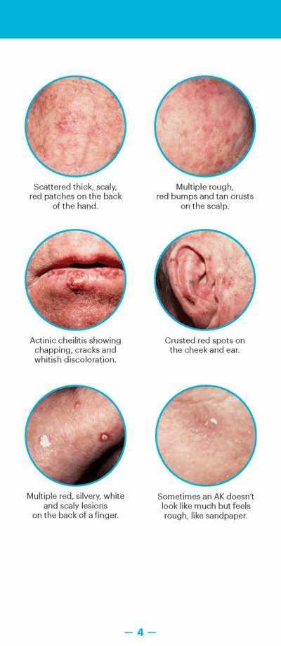 A Guide to Skin Cancers and Precancers