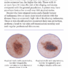 A Guide to Skin Cancers and Precancers