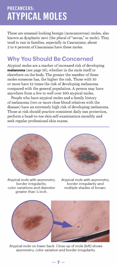 A Guide to Skin Cancers and Precancers