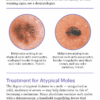 A Guide to Skin Cancers and Precancers