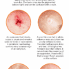 A Guide to Skin Cancers and Precancers