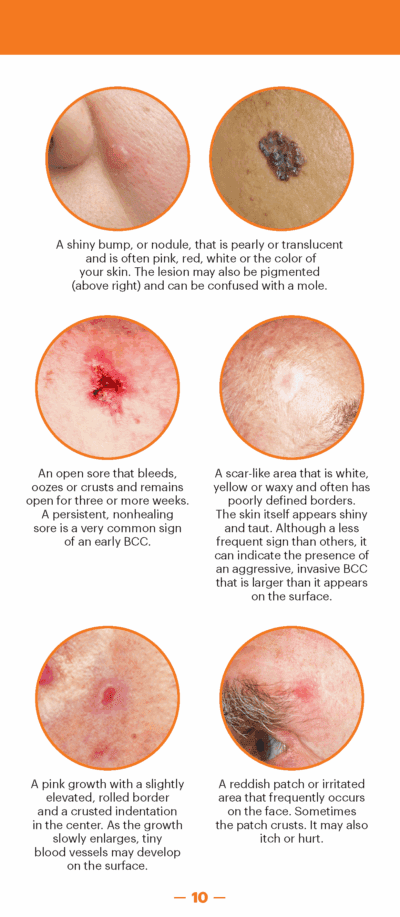 A Guide to Skin Cancers and Precancers