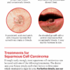 A Guide to Skin Cancers and Precancers