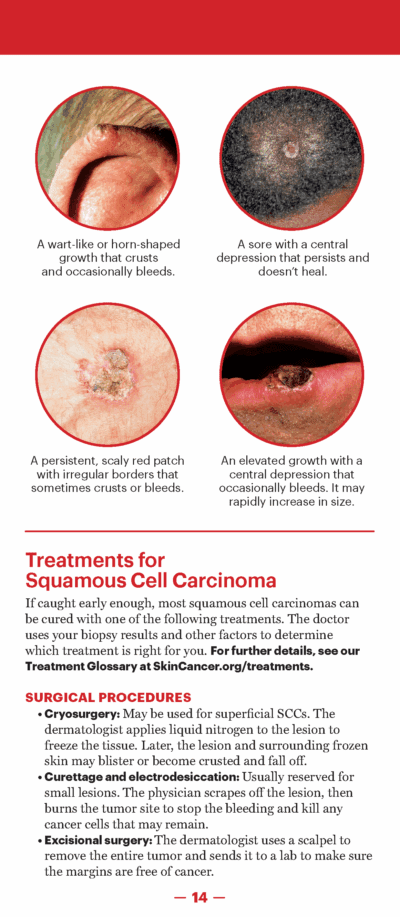 A Guide to Skin Cancers and Precancers