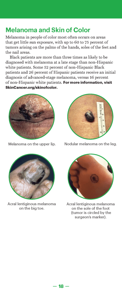 A Guide to Skin Cancers & Precancers – The Skin Cancer Foundation