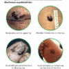 A Guide to Skin Cancers and Precancers