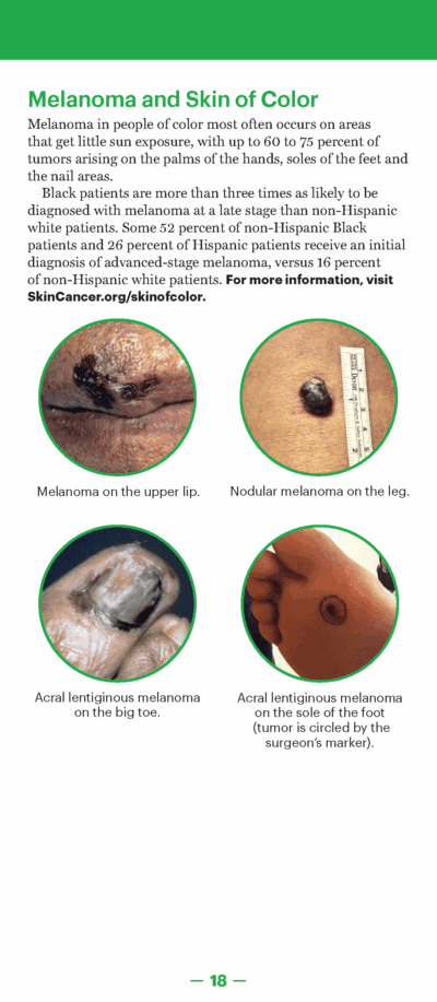 A Guide to Skin Cancers and Precancers